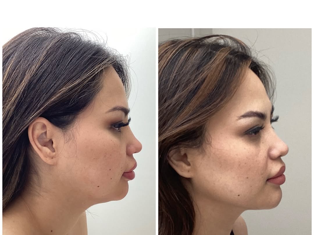 Double Chin Removal HIFU